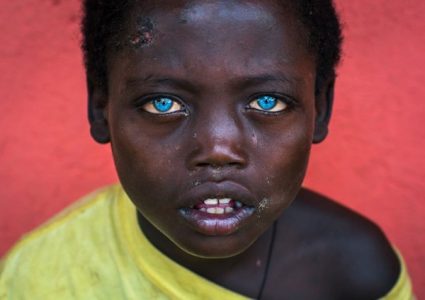Waardenburg syndrome