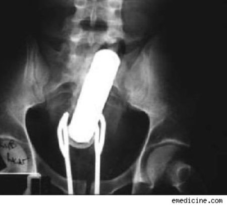 Craziest Foreign Objects Found Stuck In A Rectum Found Objects Oddee