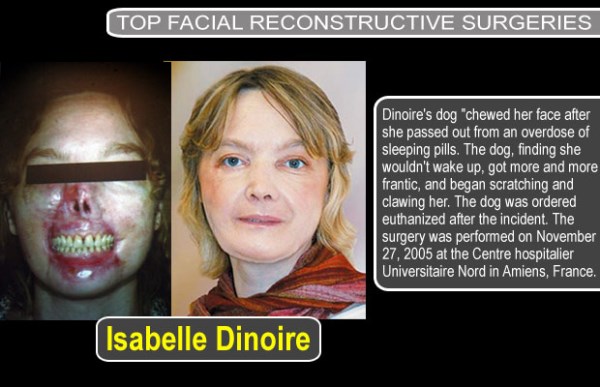 a98767 first plastics 6 face transplant