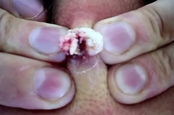 PIMPLES: 8 Most Disgusting Zip Popping Videos - Oddee