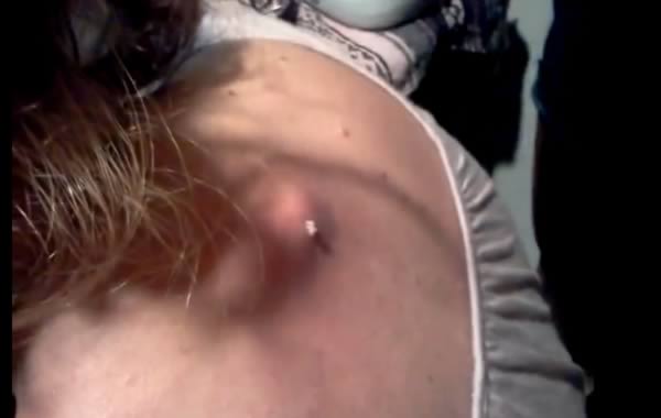 PIMPLES: 8 Most Disgusting Zip Popping Videos Oddee
