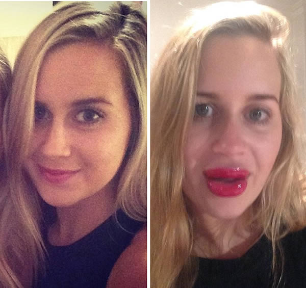  botox around lips before and after 