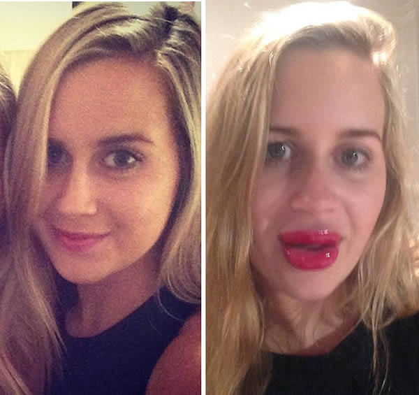 Plastic Surgery Fails 8 Lip Enhancements Gone Wrong Oddee