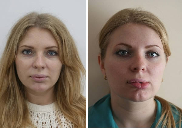 View Moderna Side Effects Fillers PNG