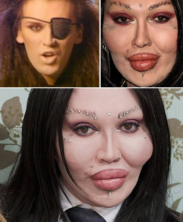  botox in lips before and after photos 