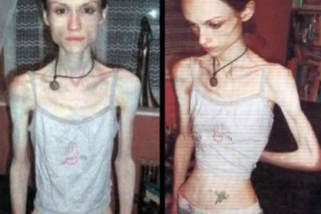 10 Most Shocking Cases of - pictures, anorexic models - Oddee